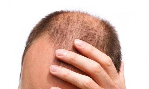 Почему выпадают волосы на голове у мужчин и женщин Что значит если выпадают волосы