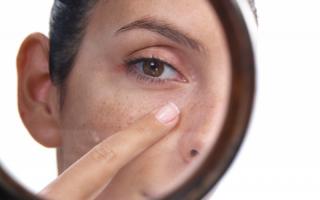 Пигментация кожи на лице: виды и способы лечения Появилось много пигментных пятен на лице